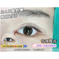 妤悦整形眼综合
