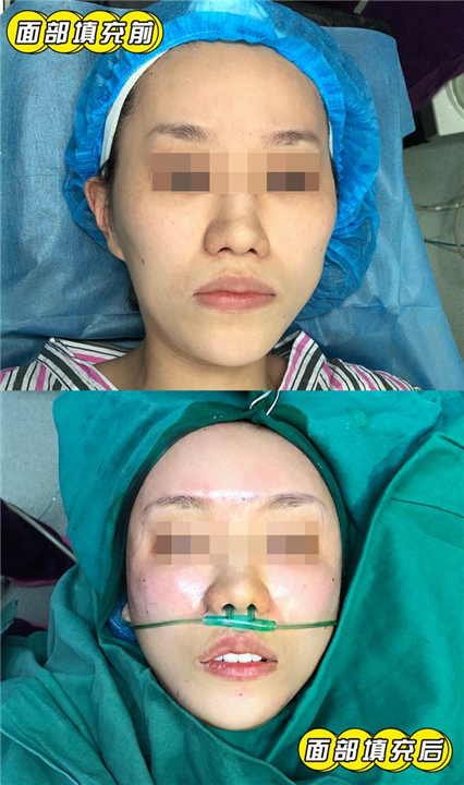 妤悦整形鼻综合