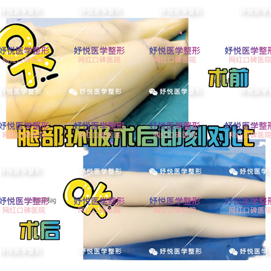 妤悦整形吸脂瘦身