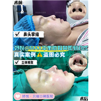 妤悦整形丰胸案例