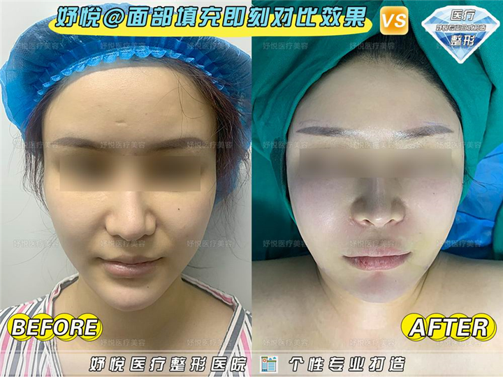 妤悦整形鼻综合