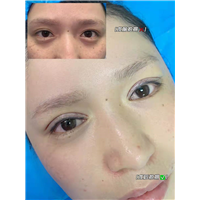 妤悦整形眼综合