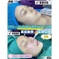 妤悦整形眼综合