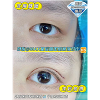 妤悦整形眼综合