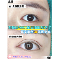 妤悦整形眼综合