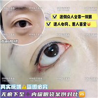 妤悦整形眼综合