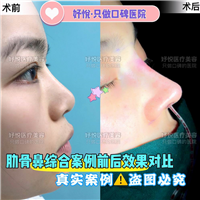 妤悦整形眼综合