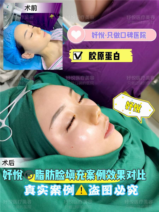 妤悦整形鼻综合