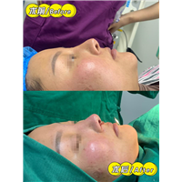 妤悦整形丰胸案例