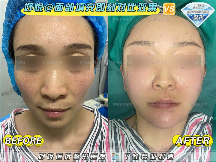 妤悦整形鼻综合