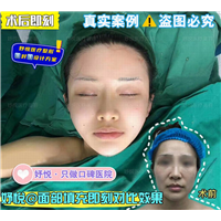 妤悦整形眼综合