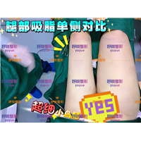 妤悦整形吸脂瘦身