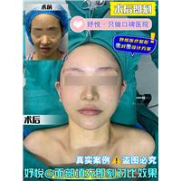 妤悦整形眼综合