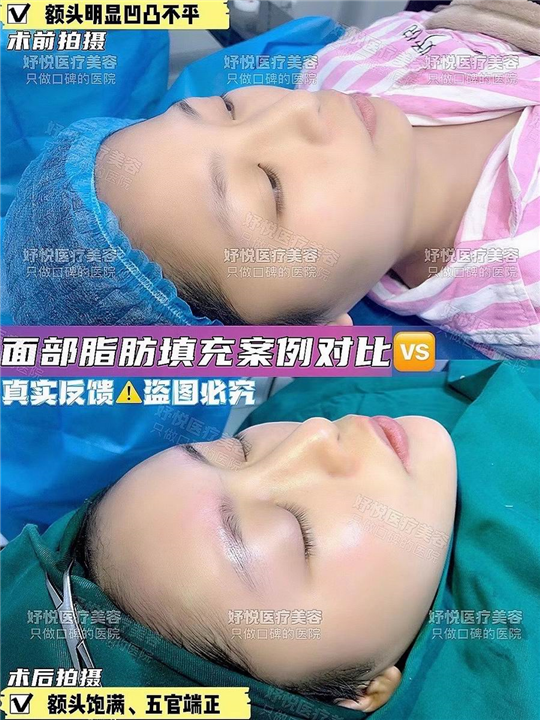 妤悦整形鼻综合