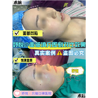 妤悦整形鼻综合