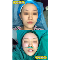妤悦整形鼻综合