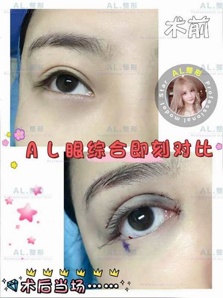 上海AL脂肪填充|上海AL自体脂肪隆胸