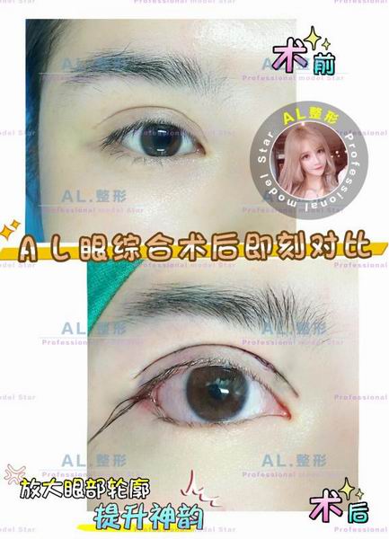 上海AL自体脂肪隆胸|上海AL吸脂瘦身