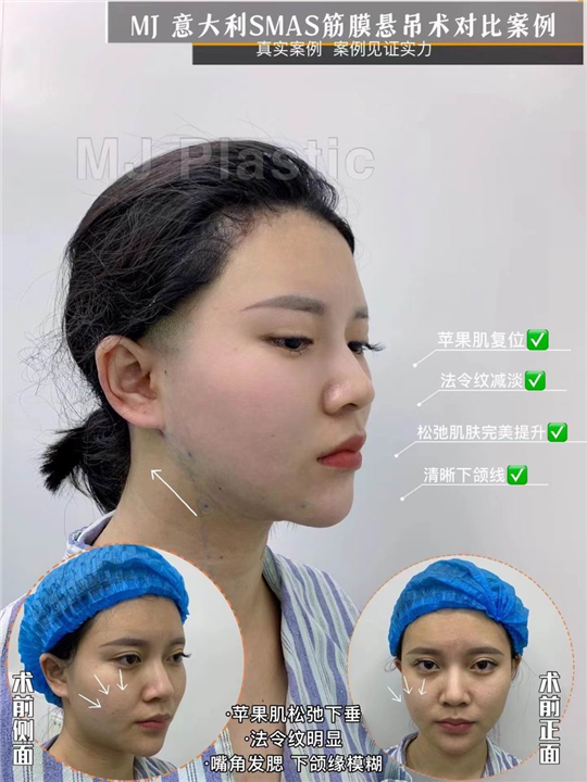 意大利筋膜悬吊术