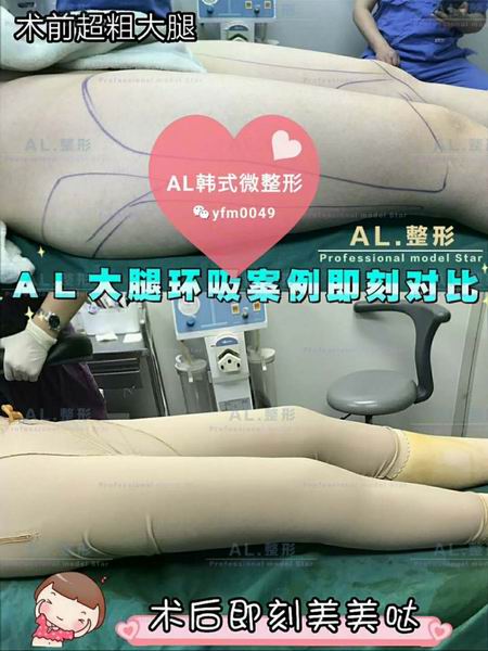 上海AL整形|上海AL鼻综合