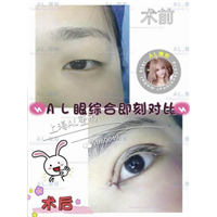 上海AL脂肪填充|上海AL自体脂肪隆胸