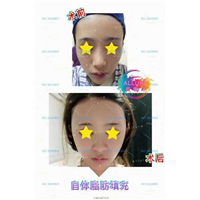 上海AL整形|上海AL鼻综合