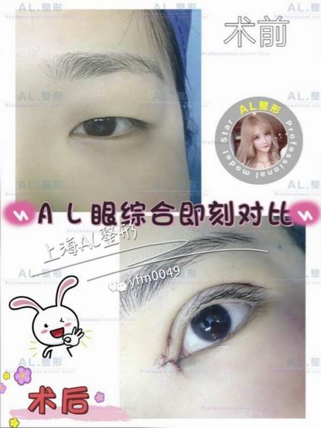 上海AL脂肪填充|上海AL自体脂肪隆胸