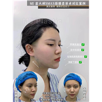 意大利筋膜悬吊术