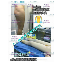 上海AL怎么样|上海人气网红整形