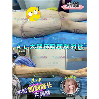 上海AL整形|上海AL鼻综合