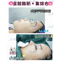 上海AL眼综合|上海AL脂肪填充