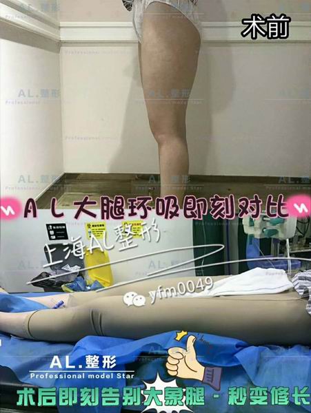 上海AL整形|上海AL鼻综合