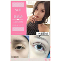 上海AL脂肪填充|上海AL自体脂肪隆胸