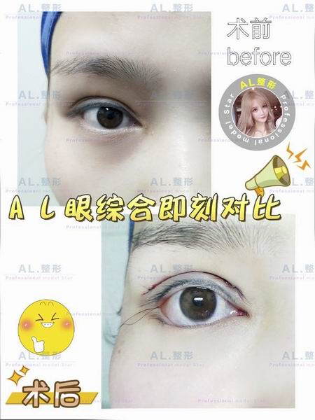 上海AL脂肪填充|上海AL自体脂肪隆胸