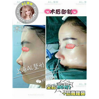 上海AL整形|上海AL鼻综合