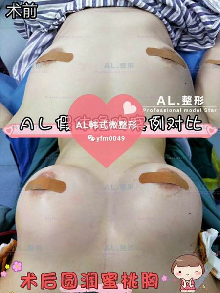 上海AL眼综合|上海AL脂肪填充