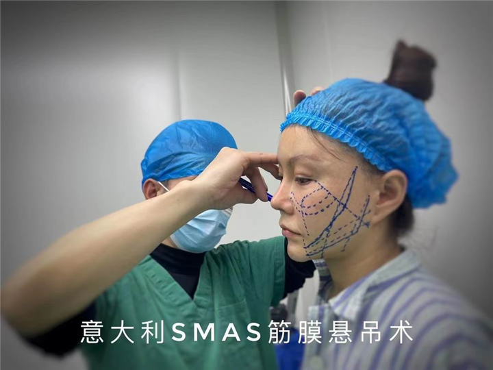 意大利SMAS筋膜悬吊术