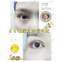 上海AL脂肪填充|上海AL自体脂肪隆胸