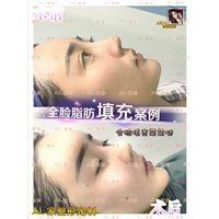 上海AL整形|上海AL鼻综合