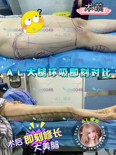 上海AL整形|上海AL鼻综合