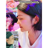 舒铂超肋鼻综合术后12天反馈