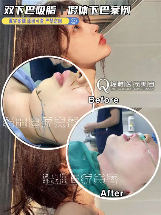 广州网红整形修复