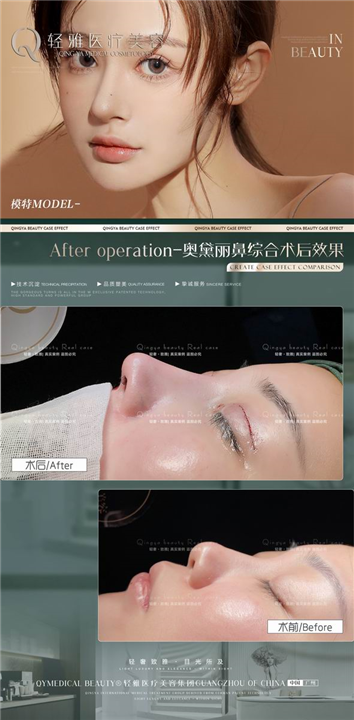 广州鼻综合整形修复