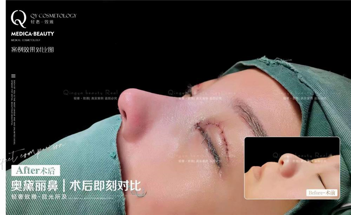 广州鼻整形修复医院