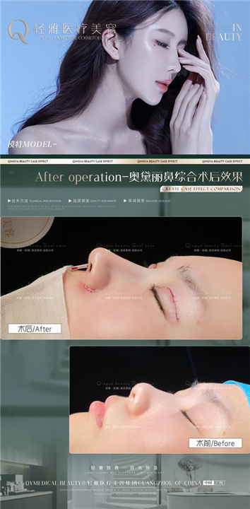 广州鼻整形修复医院