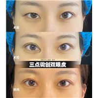 李洋双眼皮整形