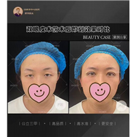 李洋双眼皮整形