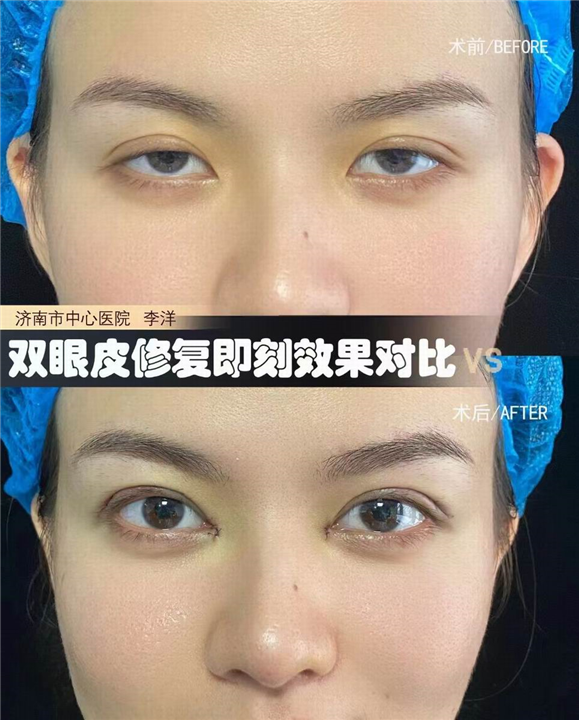 李洋双眼皮整形
