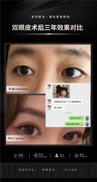 李洋双眼皮整形