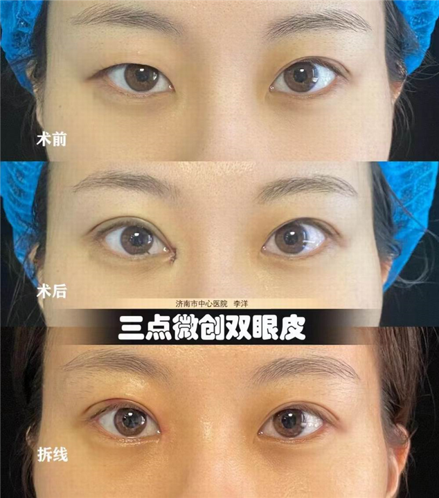 李洋双眼皮整形